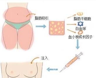 吸脂隆胸价钱大概需要多少?影响价格因素分析