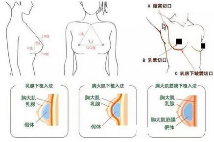 假体丰胸图片步骤