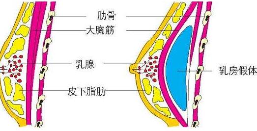 硅胶假乳对身体有害吗?