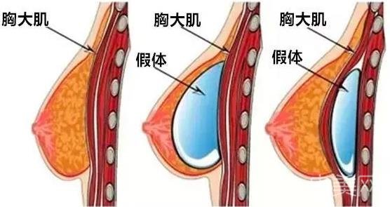 隆胸方式你更偏向于假体还是自体脂肪？有什么区别？