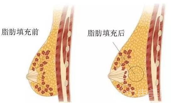 堪比软黄金的自体脂肪，拿来隆胸*果咋样？