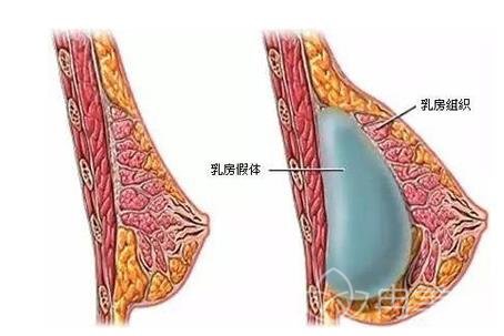 隆胸手术竟然存在这些你不知道的危害！