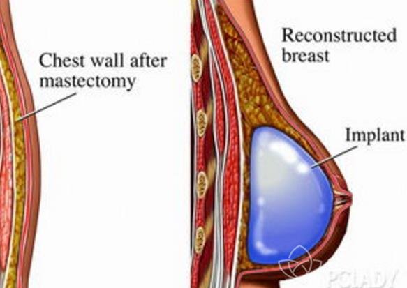 假体隆胸术后包膜挛缩怎么办？修复很重要！