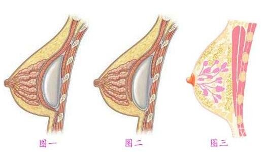 广州假体丰胸的费用是多少？自体脂肪和假体隆胸信息介绍？