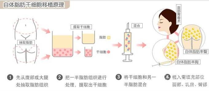 北京自体脂肪隆胸多少钱?