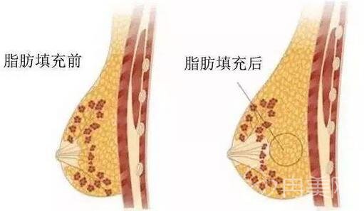 自体脂肪丰胸后疼多久才能恢复啊？