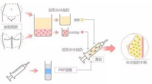 自体脂肪丰胸后怎么保养才能够更加自然？