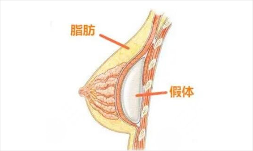 黄双闻医生_假体隆胸案例分享