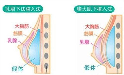 黄双闻医生_假体隆胸案例分享