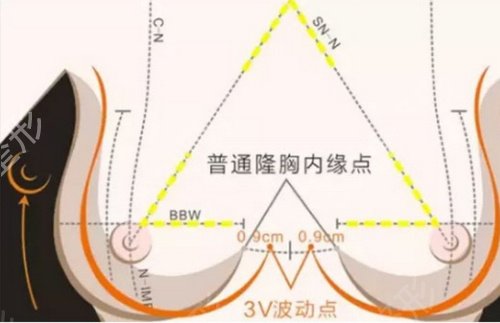 花样年华假体好不好?花样年华假体隆胸案例~