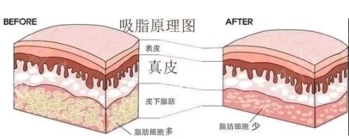 副乳吸脂*果吗？