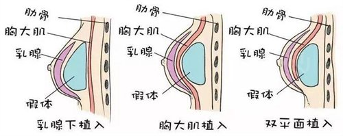 现在做哪种隆胸手术*？