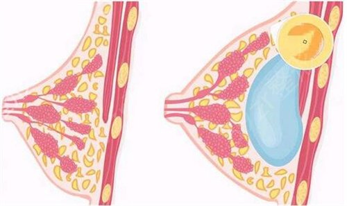 假体丰胸手术多少钱？假体丰胸盘点！