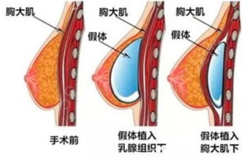 女子嫌隆胸后像大茄子，才知道原来隆胸存在这么多潜规则...