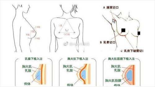 女子嫌隆胸后像大茄子，才知道原来隆胸存在这么多潜规则...