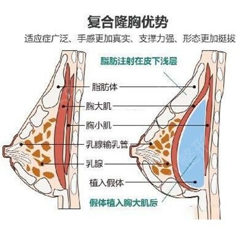 平胸妹子如何逆袭？假体隆胸之国产和进口常见品牌分析