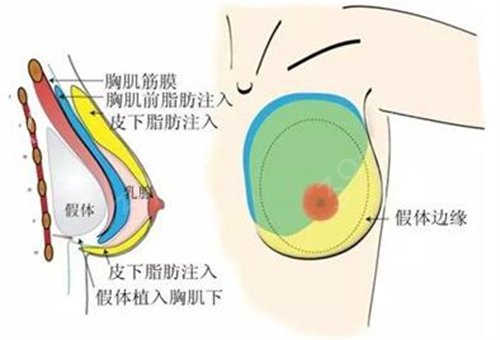 自体脂肪丰胸后变硬？不要慌，按照以下方式护理准没错