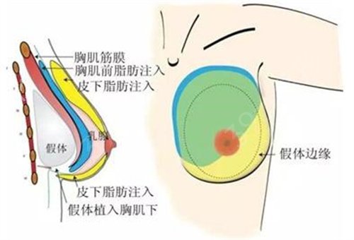 抽脂隆胸能坚持几年?能不能多注射脂肪?