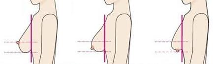 乳房下垂整形费用是多少
