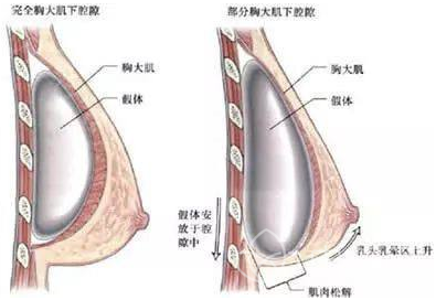 假体隆胸品牌有哪些？怎么选择品牌啊？