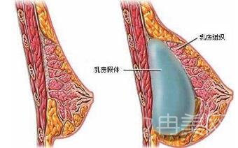 国产的隆胸假体哪种好？产品推荐