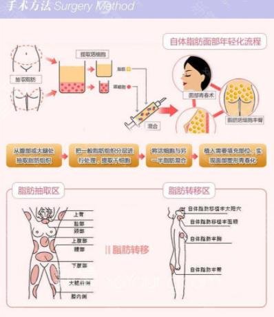 自体脂肪可以填充哪些部位?假体隆胸与自体隆胸的比较