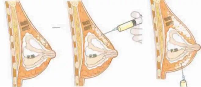 自体脂肪隆胸靠谱吗，一次可以增加两罩杯以上吗
