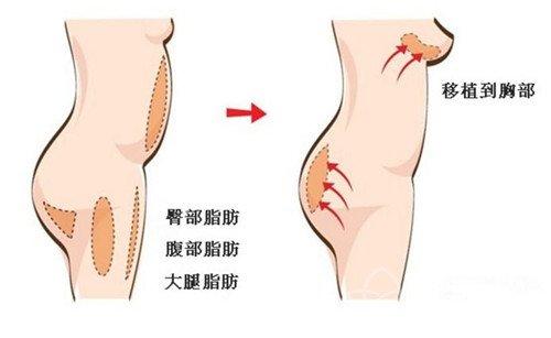 哪些人适合做自体脂肪隆胸？适宜人群列举