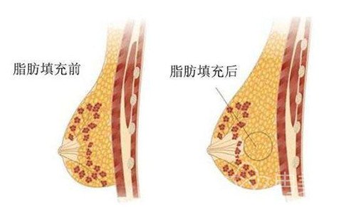 哪些人适合做自体脂肪隆胸？适宜人群列举