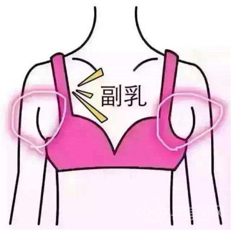 副乳吸脂术后几天可以恢复？要传塑身衣吗？