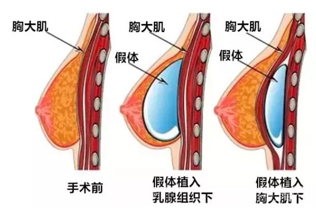 假体隆胸术前必须了解的知识!想进行隆胸的妹子看过来